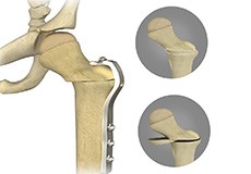Femoral Derotational Osteotomy