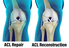 ACL Reconstruction Surgery: Graft Options