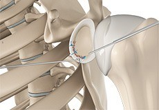 Arthroscopic Labral Repair