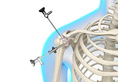 Arthroscopic Frozen Shoulder Release