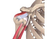 Arthroscopic Superior Capsular Reconstruction (SCR)