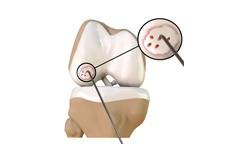 Cartilage Microfracture