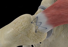 Open Gluteus Medius Repair