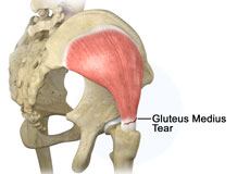 Gluteus Medius Tear