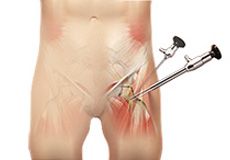 Hip Arthroscopy