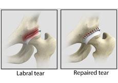 Hip Labral Repair