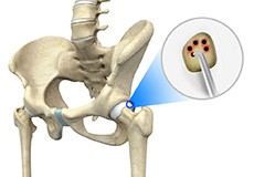 Hip Microfracture