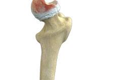 Hip Osteonecrosis