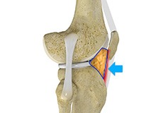 Hoffa's Fat Pad Syndrome