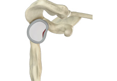 Revision Open Labral Repair