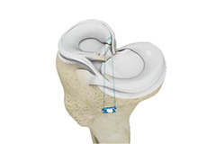 Meniscus Root Repair