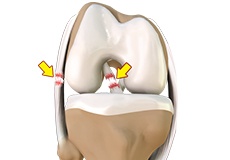 Multiligament Knee Injuries