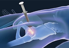 Orthobiologics for the Hip