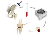 Regenerative Medicine for Sports Injuries