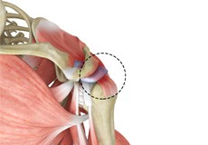 Rotator Cuff Pain