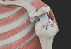 Rotator Cuff Repair