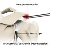 Subacromial Decompression